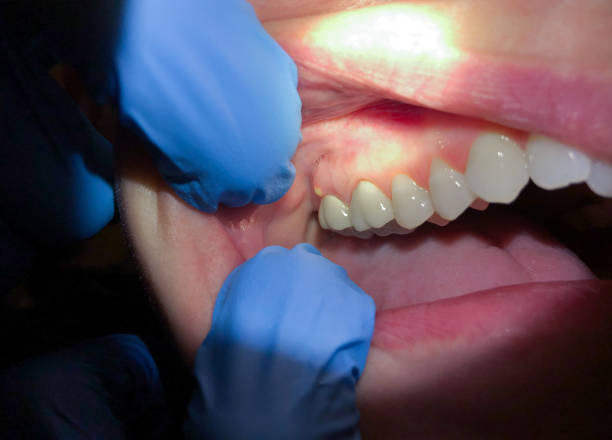 Best Emergency Treatment for Toothache in Jacksonville, AL