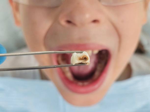Best Emergency Broken Tooth Repair in Jacksonville, AL