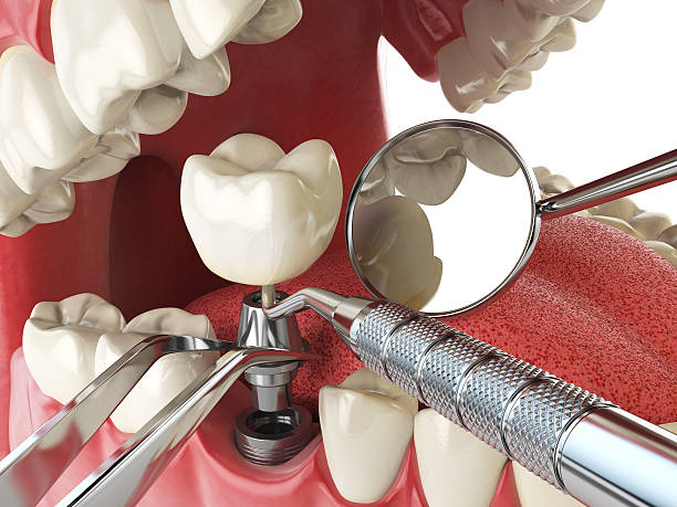 Best Emergency Root Canal Treatment in Jacksonville, AL